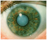 auroh homeopathy cataract - cortical cataract