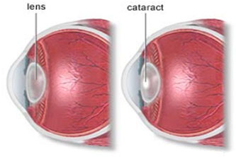 auroh homeopathy cataract - lens and cataract