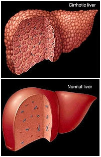 auroh homeopathy cirrhosis of liver - cirrhotic liver and normal liver
