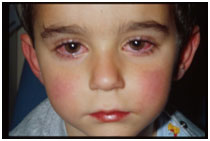 auroh homeopathy conjunctivitis