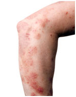 auroh homeopathy eczema - nummular dermatitis