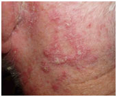 auroh homeopathy eczema - seborrheic dermatitis