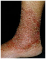 auroh homeopathy eczema - stasis dermatitis