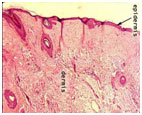 auroh homeopathy lichen planus - normal skin