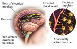 auroh homeopathy migraine