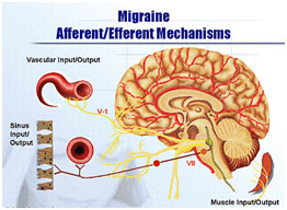 auroh homeopathy migraine - afferent/efferent mechanisms