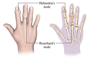 auroh homeopathy osteoarthritis - heberden's node and bouchard's node