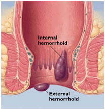auroh homeopathy piles or hemorrhoids