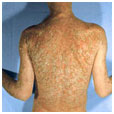 auroh homeopathy psoriasis - erythrodermic psoriasis