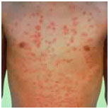 auroh homeopathy psoriasis - guttate psoriasis