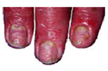 auroh homeopathy psoriasis - psoriatic nails