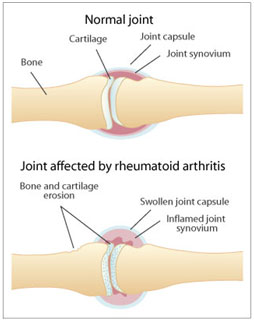 auroh homeopathy rheumatoid arthritis