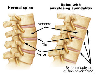 auroh homeopathy spondylitis - normal spine and spine with ankylosing spondylitis