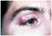 auroh homeopathy stye - chalazion