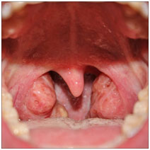 auroh homeopathy tonsillitis